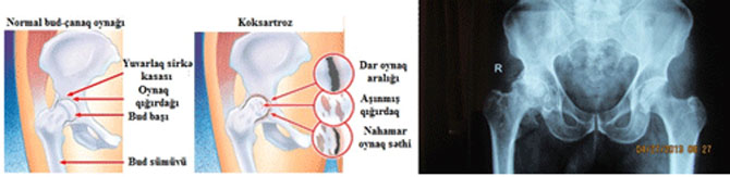 Bud çanaq oynağı endoprotezlesdirilmesi Artroplastika