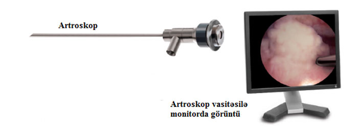 artroskop